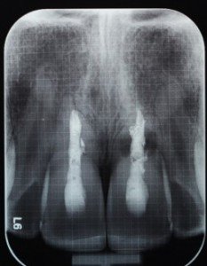santiago-gonzalez-implante-unico-2
